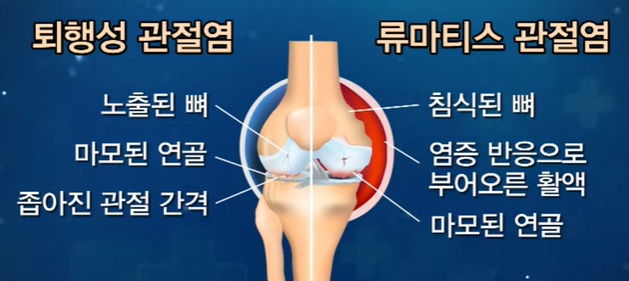 전신성 홍반성 루푸스 및 류마티스 관절염 증상 진단을 위한 내원 진료