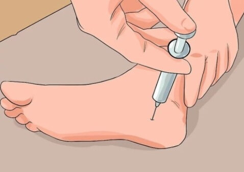 발바닥에 주사를 놓는 치료법