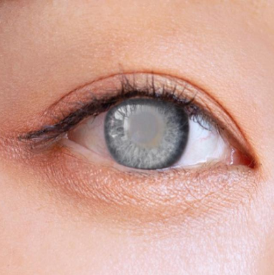 백내장으로 뿌옇게 된 눈동자