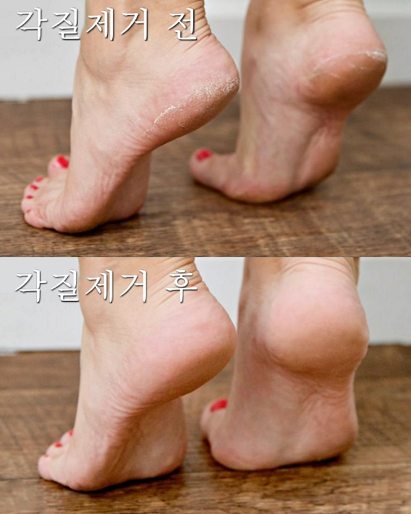 발뒤꿈치 각질제거 갈라짐,뒤꿈치 굳은살 제거,레몬껍질,풋크림