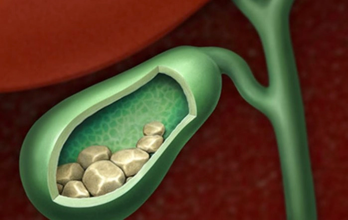 담적병 증상 위 담적 치료방법 및 담적병에 좋은 음식 추천
