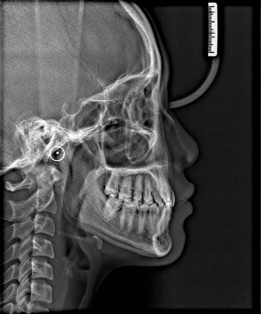 턱교정 시작 전 두부방사선 사진