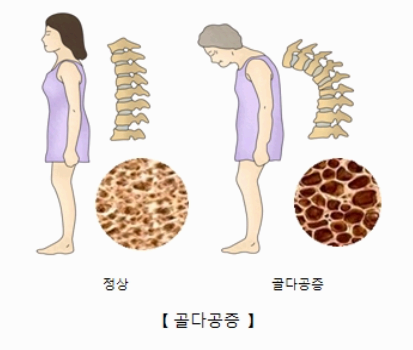 골다공증 이미지사진