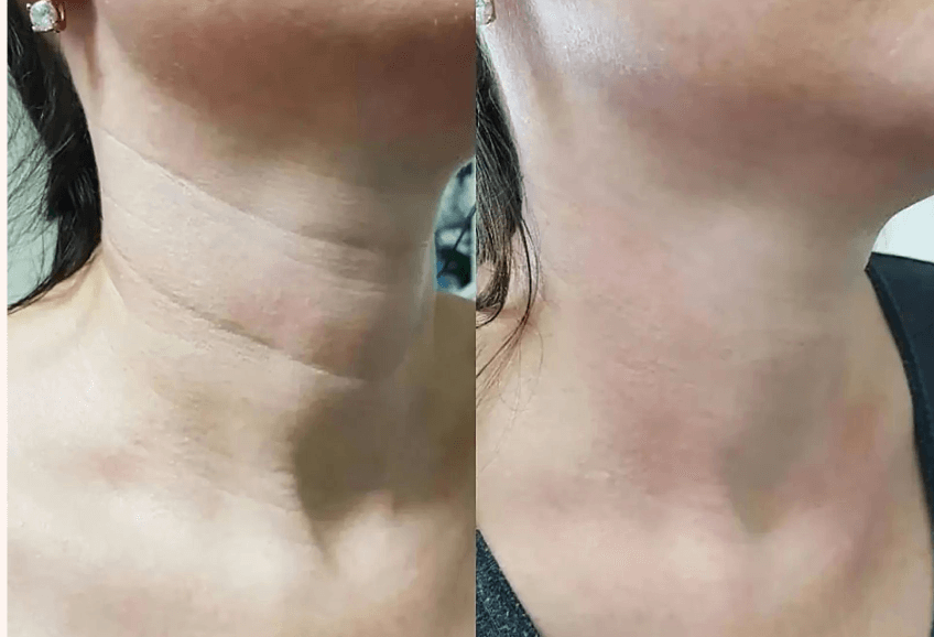 벨로테로 목주름