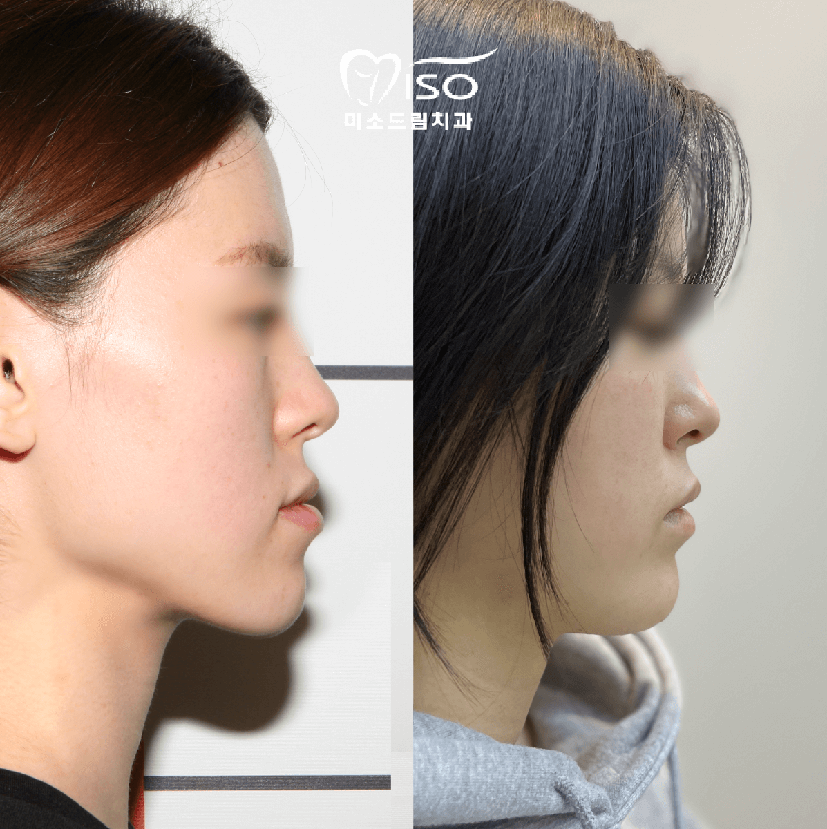 주걱턱-교정-전후