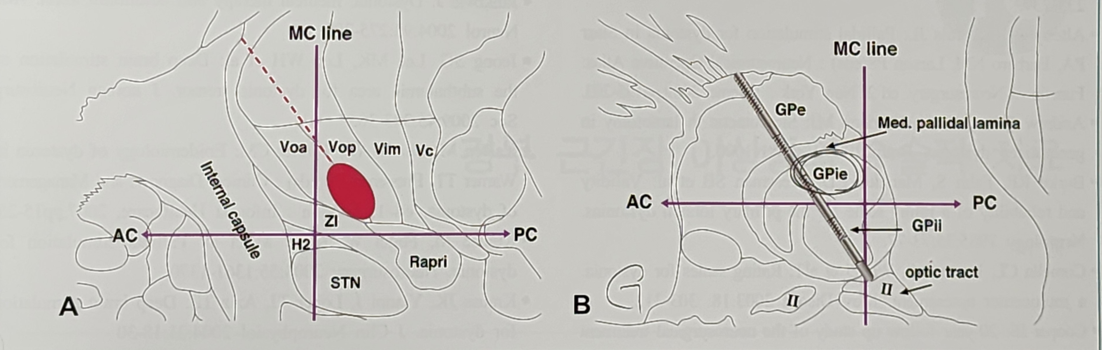 근긴장이상증의 수술적 치료
