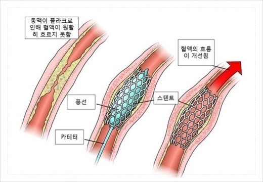 스탠트 삽입