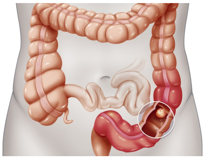 대장내시경-용종제거-선종제거-보험청구-방법안내
