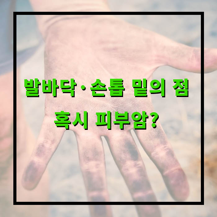 흑색종 증상, 치료법, 전이될까?