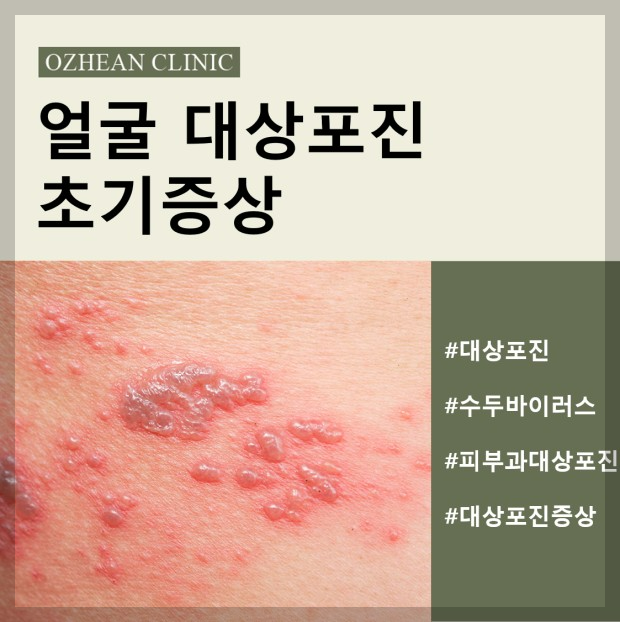 대상포진: 이해와 예방