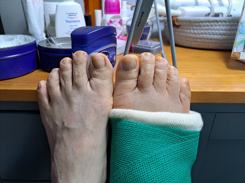 아킬레스건 파열 후기 4-무서운 계단, 운전은 언제부터? 그리고 근손실!