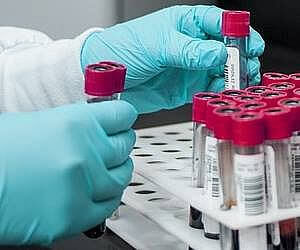 호모시스테인 수치 검사