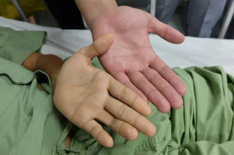 초록색 환자복을 입은 황달 환자가 본인의 노란색의 손과 정상적인 붉은 색의 손을 비교하고 있는 것을 찍은 사진