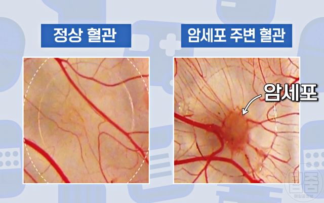 암세포 굶기는 식사법,브로콜리 줄기 효능 먹는법,팁줌