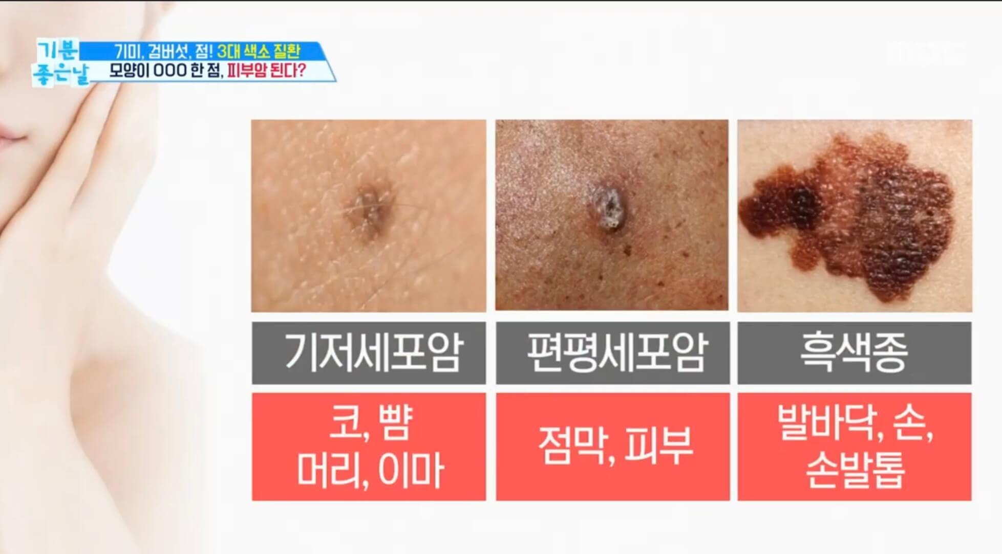피부암