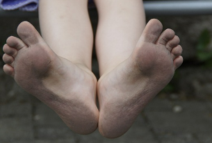 맨발 걷기 부작용