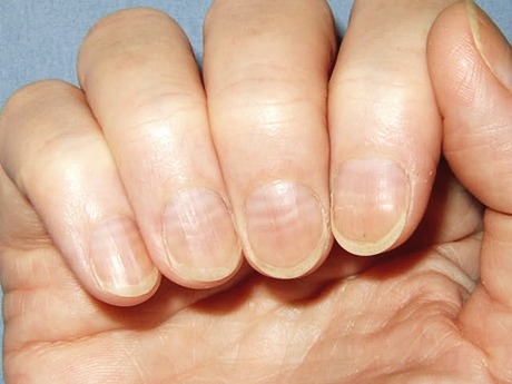 손톱 가로줄 생기는 원인과 손톱 부러짐 증상 정보로 케라틴 비오틴 철분 칼슘 등 영양 성분을 통한 손톱 건강 관리 방법을 보여주는 네일 케어 이미지