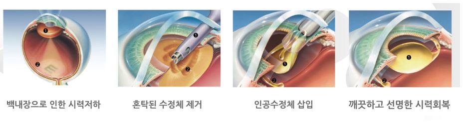 백내장-수술과정