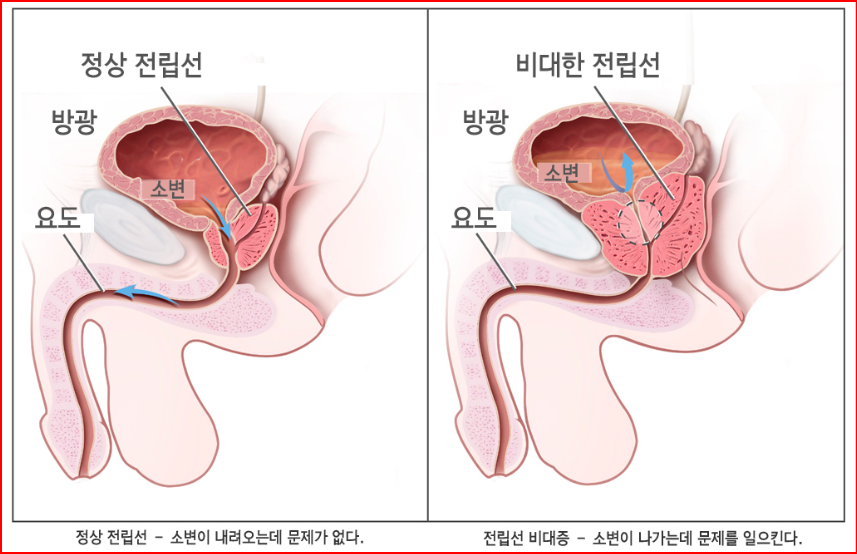 alt="전립선 비대증 수술의 필요성"