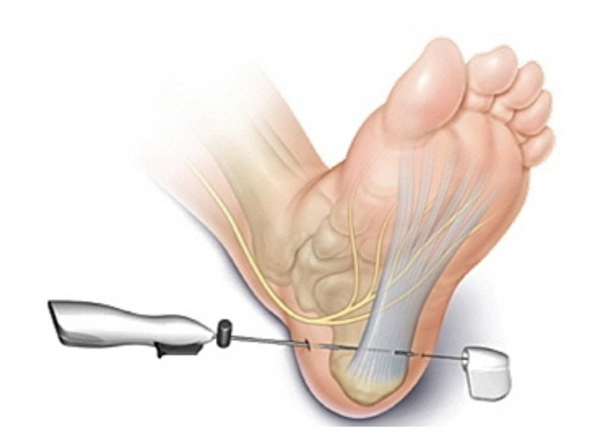 족저근막염 수술