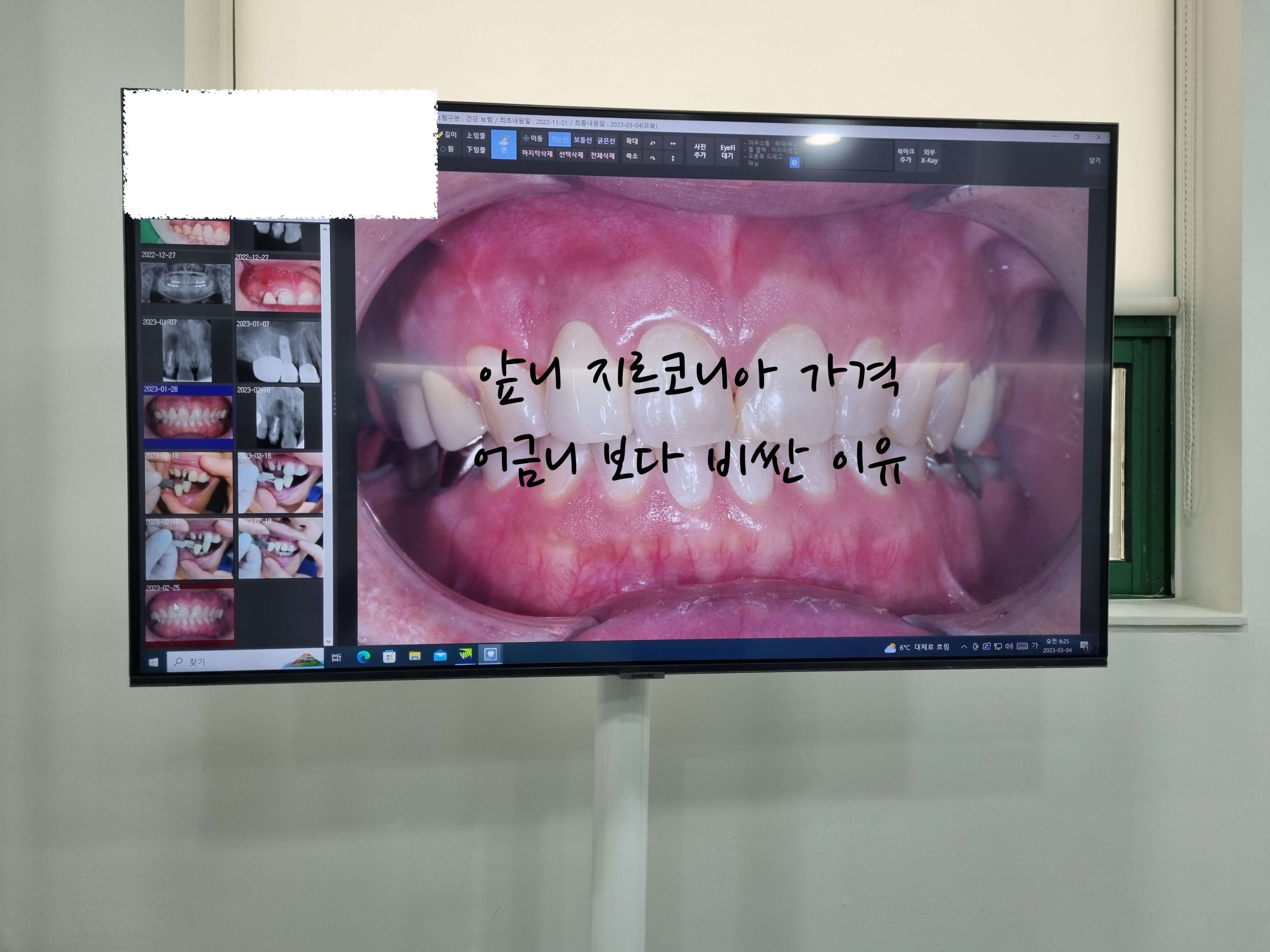앞니 지르코니아