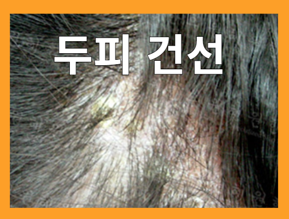 두피 질환 - 건선