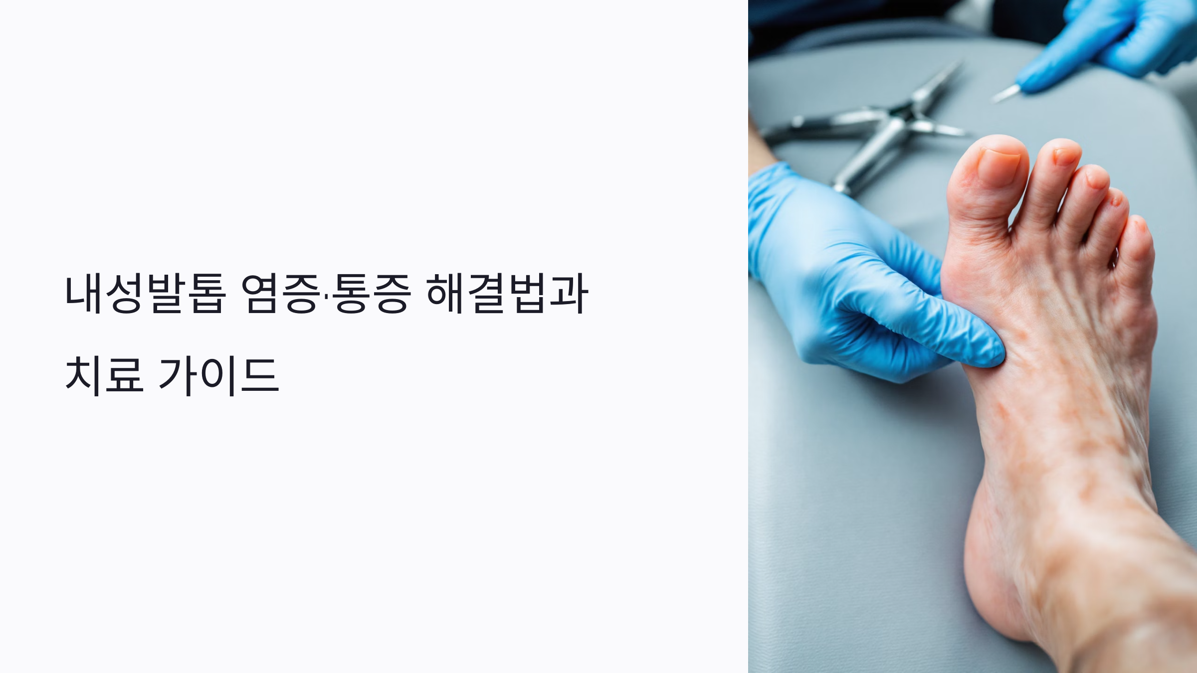 피부를 찌르는 발톱이 만드는 내성발톱 염증 증상과 치료