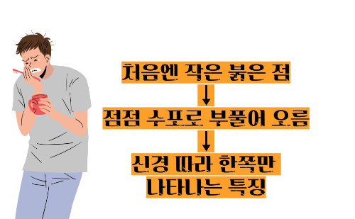 대상포진 초기증상