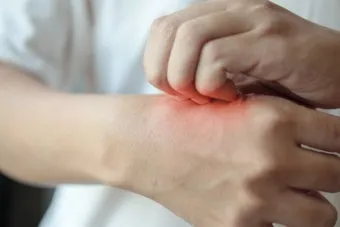 모기 물려 가려울 때 땀띠에 안티푸라민 연고 효능 부작용 사용후기_22