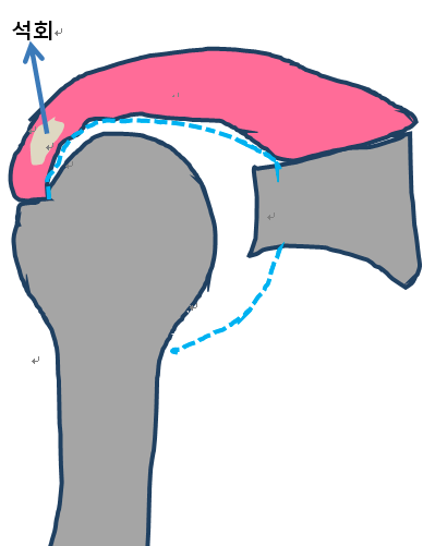 어깨 힘줄 부위에 석회가 쌓여있는 모습