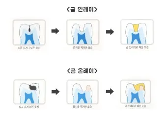 인레이 온레이의 차이와 치료 방법_8