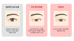 쳐진 눈