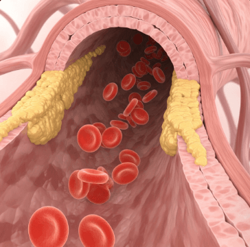 고지혈증 약 종류와 효과1