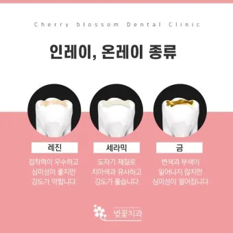 인레이 온레이의 차이와 치료 방법_11