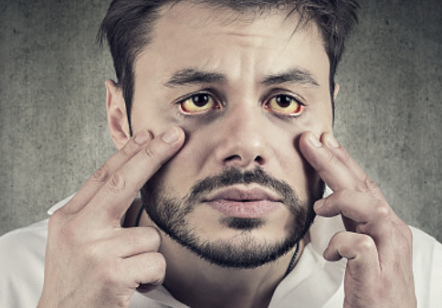 간경화 초기증상 12