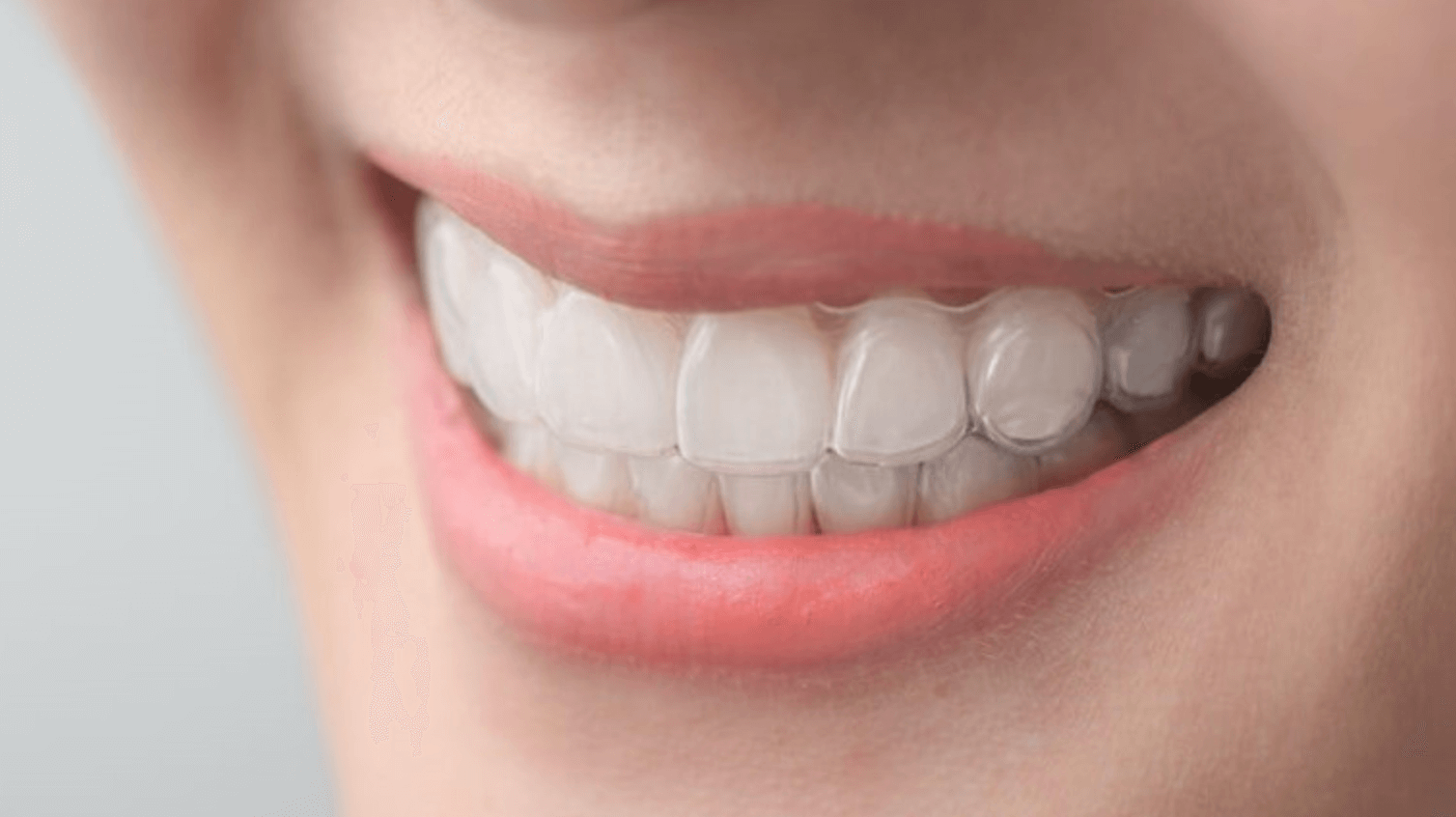 투명 교정기 장단점