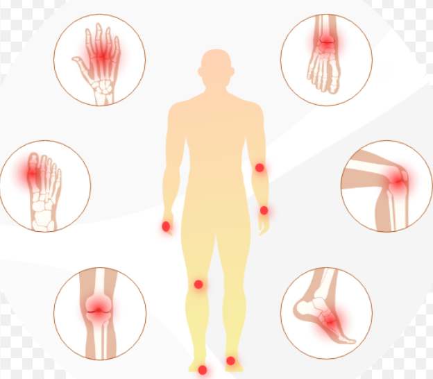 통풍 발생 부위