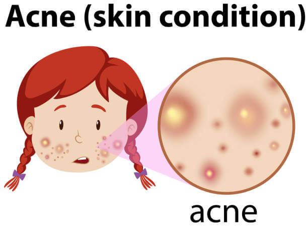 지성 피부 (Oily Skin)