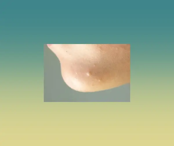 사마귀-생기는-원인-증상-제거-자연-소멸