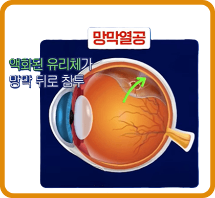 눈 검은것이떠다니는것