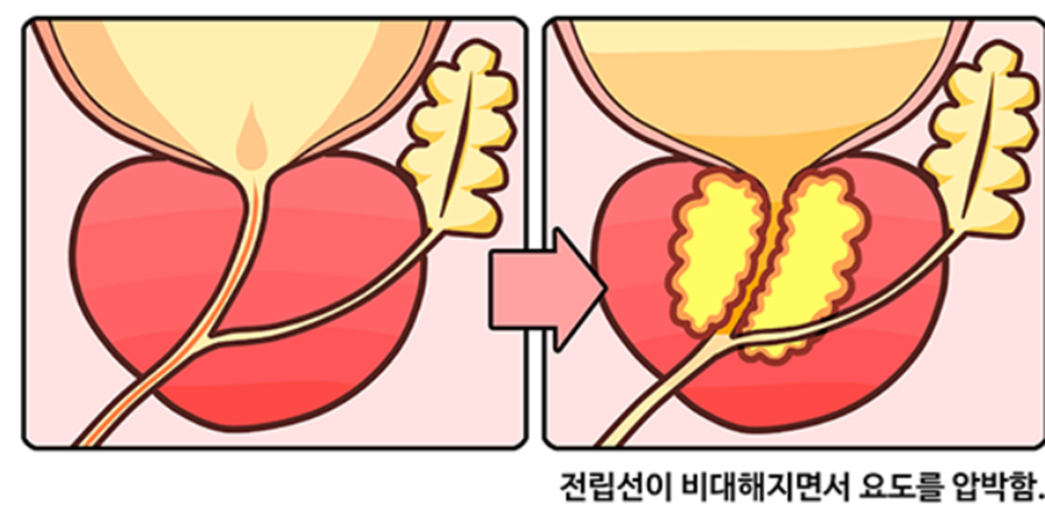 전립선 비대증-사진