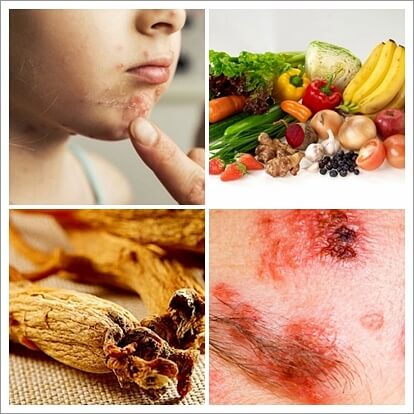 대상포진에 좋은 음식