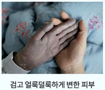 검게 변한 피부 지영이