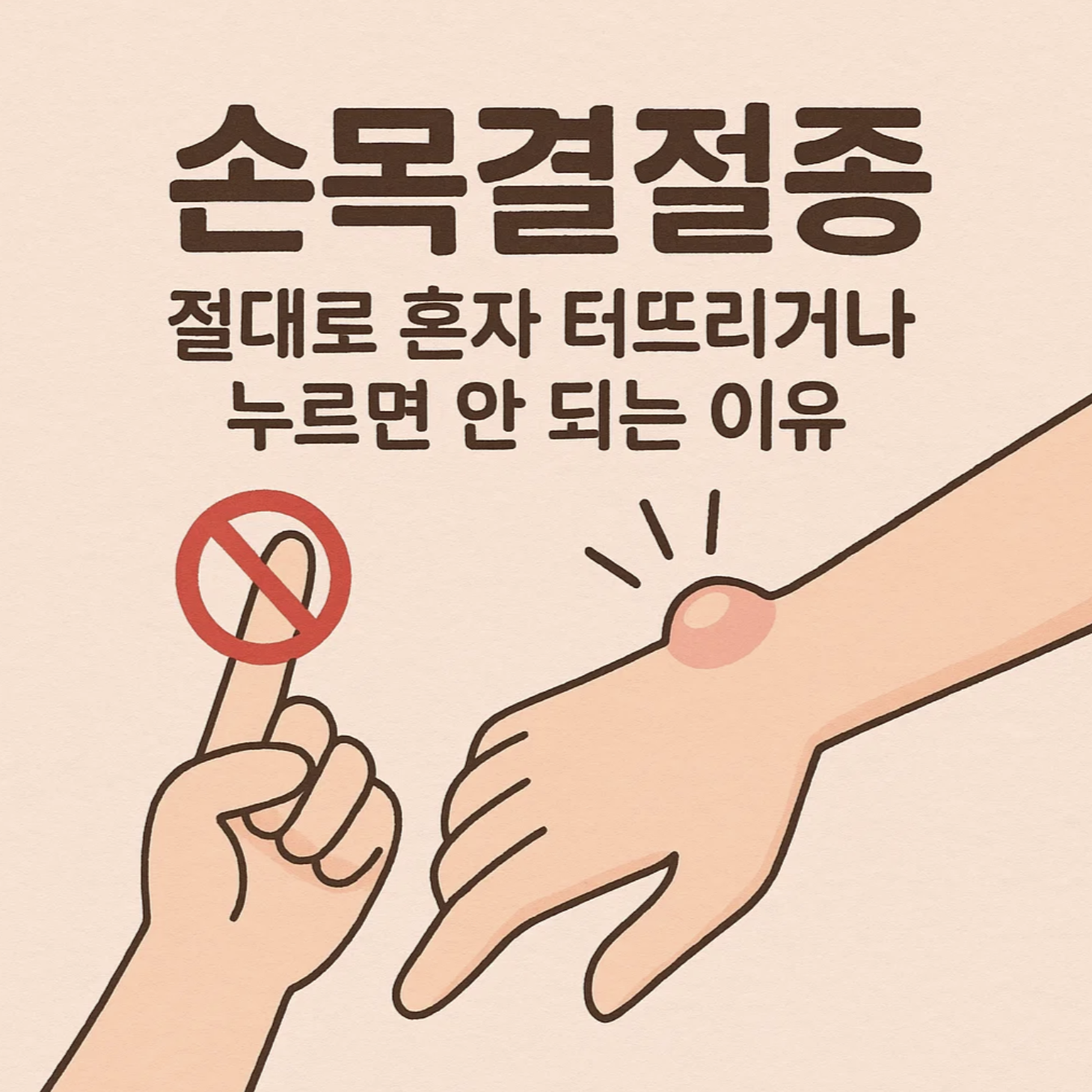 손목결절종, 절대로 혼자 터뜨리거나 누르면 안 되는 이유