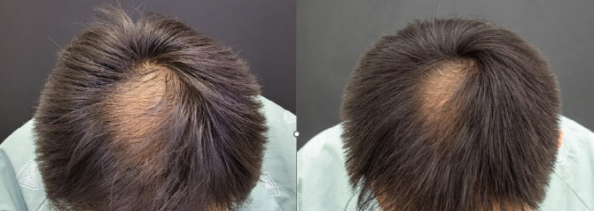 줄기세포 탈모 치료 후 풍성해진 모발의 변화를 보여주는 사진