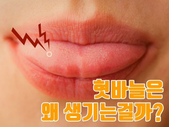 혓바늘 원인 없애는 법 혓바늘 알보칠 사용