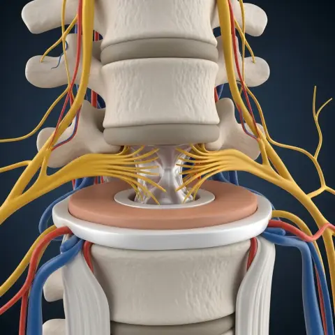 허리디스크는 디스크가 신경을 압박해 허리와 다리에 통증을 유발합니다.