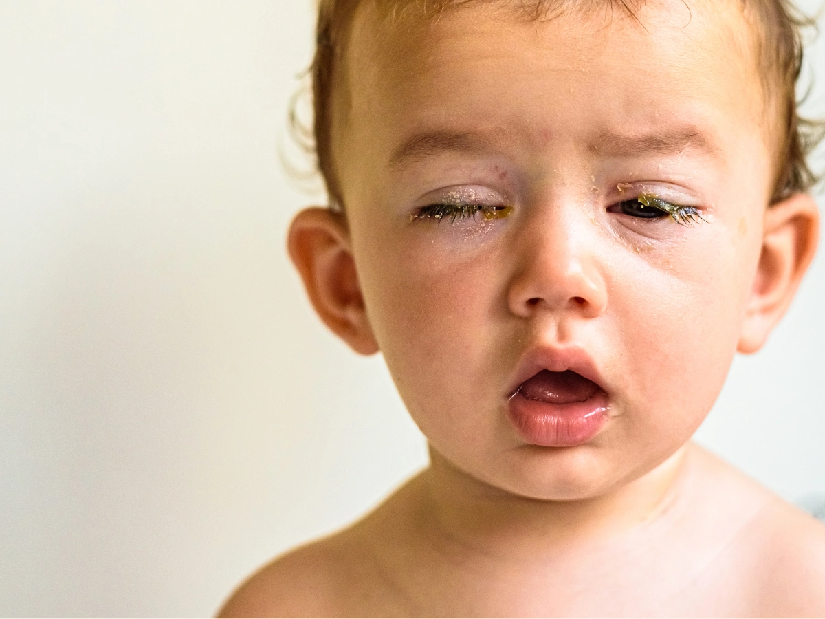 눈꼽이 낀 아이