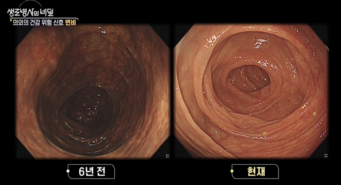 생로병사의 비밀, 변비, 몸이 보내는 위험신호