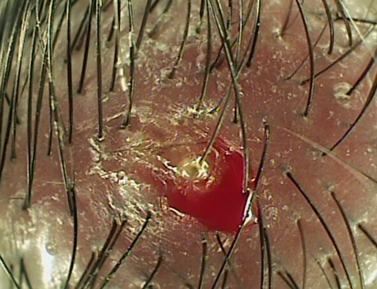 두피가려움증지루성피부염